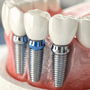 Full arch implant dentistry