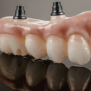 Advanced Implant Prosthodontics