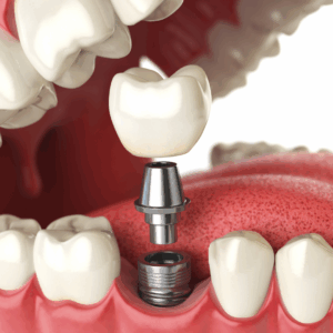 Dental Implant Fundamentals