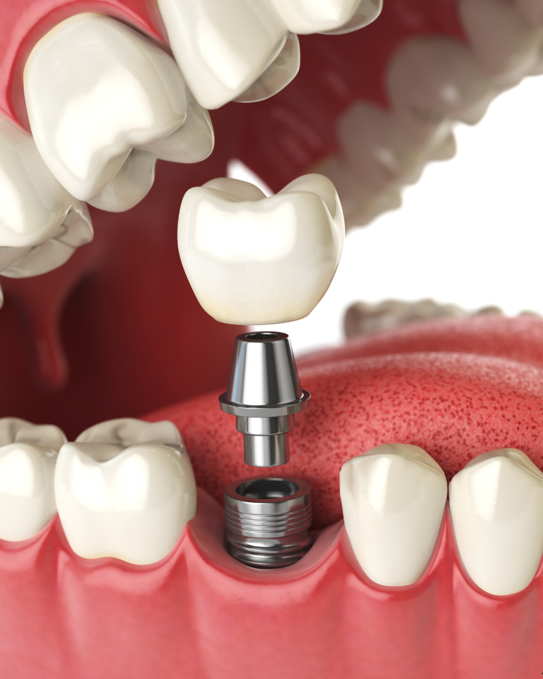 Dental Implant Fundamentals