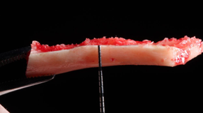 Advanced Guided Bone Regeneration