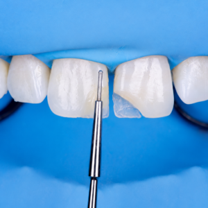 Anterior Composites
