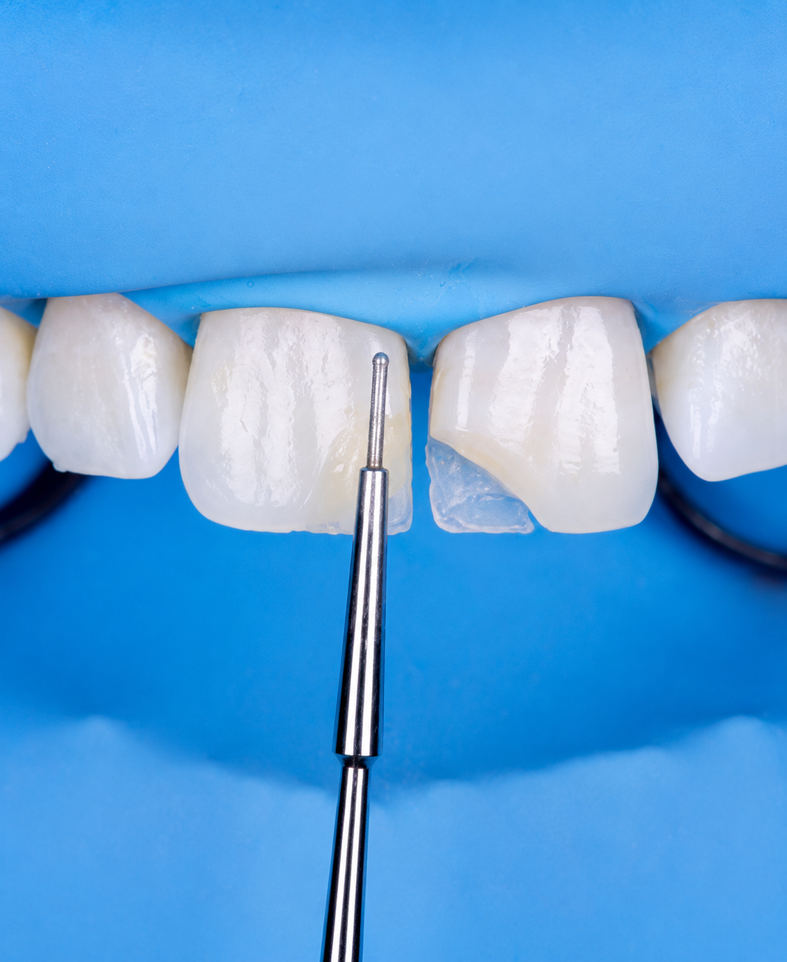 Anterior Composites