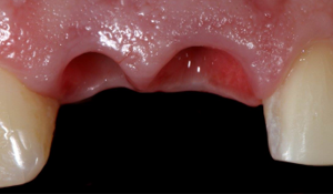 Basics in Soft Tissue Management