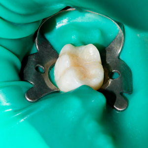 Basics of Endodontic Therapy