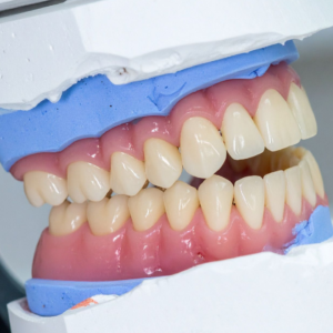 Complete Dentures