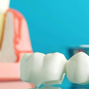 Posterior Adhesive Restorations