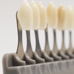 Esthetic Rehabilitation with Ceramic Veneers