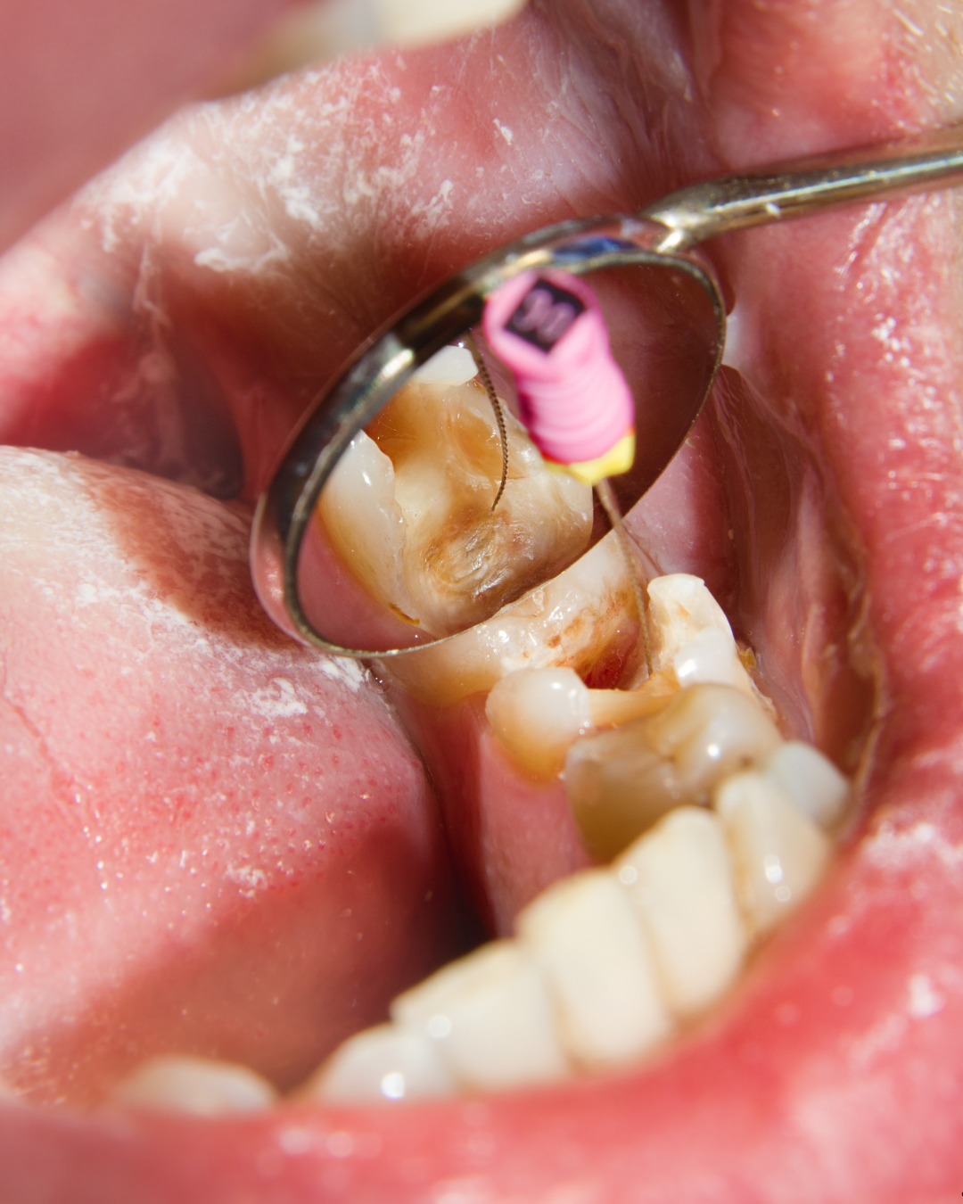 Basics of Endodontic Therapy