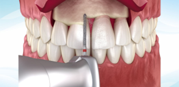 Crown Lengthening