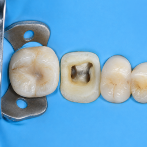 Endodontic Retreatment