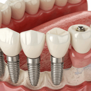 Fixed Implant Rehabilitation