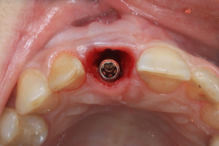 Immediate Implant Placement in the Esthetic Region