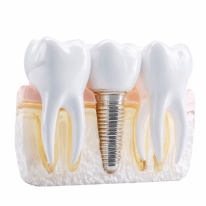 Introduction to Implant Dentistry