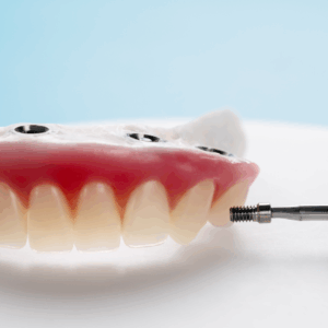 Implant-Supported Overdentures