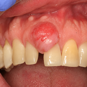 Oral and Maxillofacial Pathology
