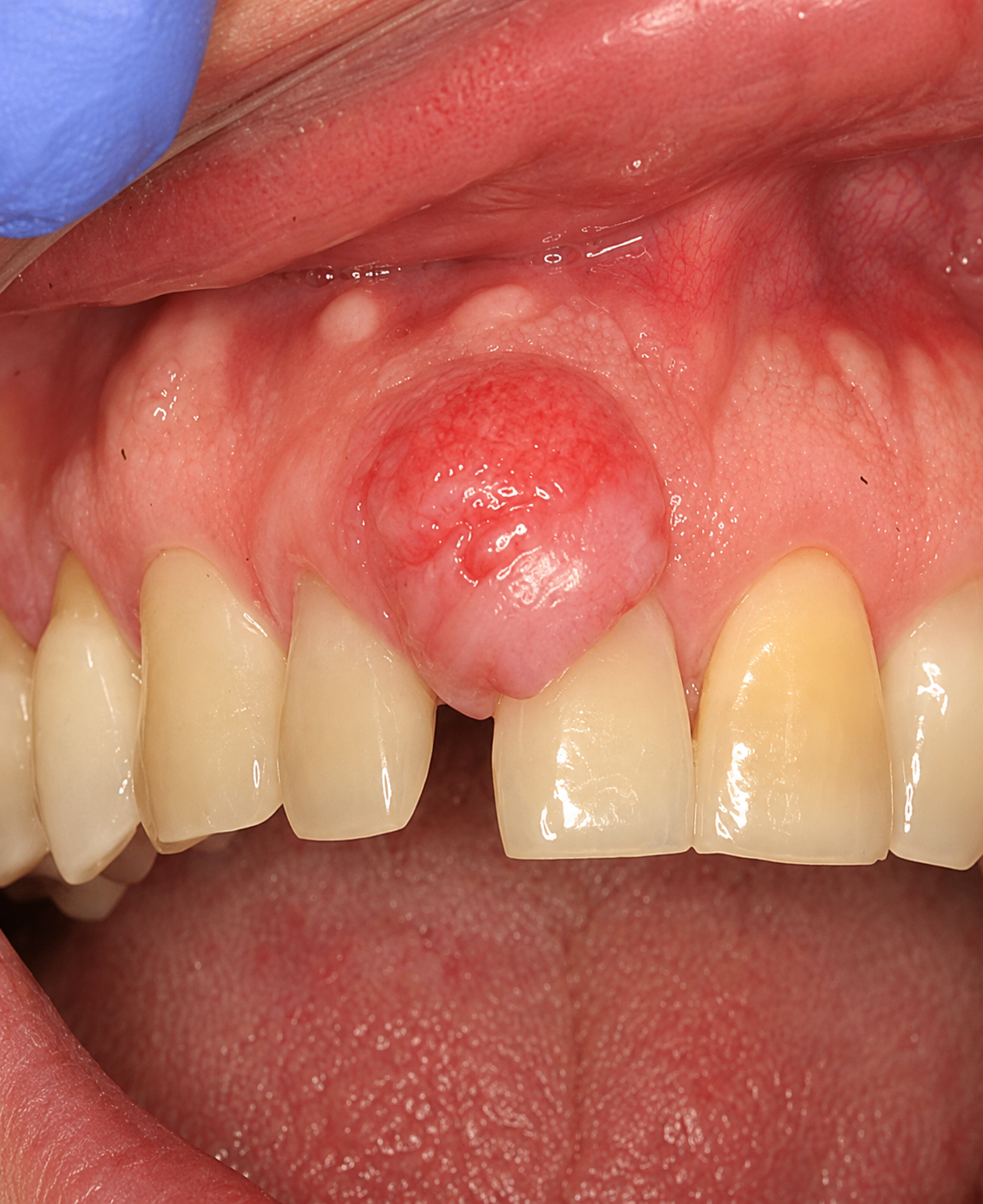 Oral and Maxillofacial Pathology