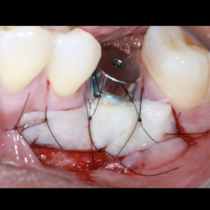 Soft Tissue Management Around Implants