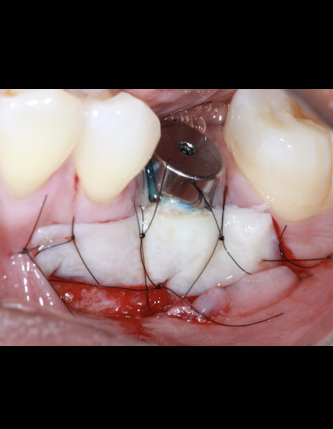Soft Tissue Management Around Implants